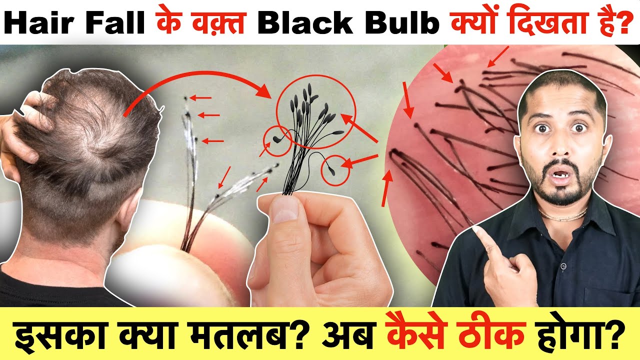 Hair Fall with Black Bulb Explained: Causes & Solutions for Healthy Hair