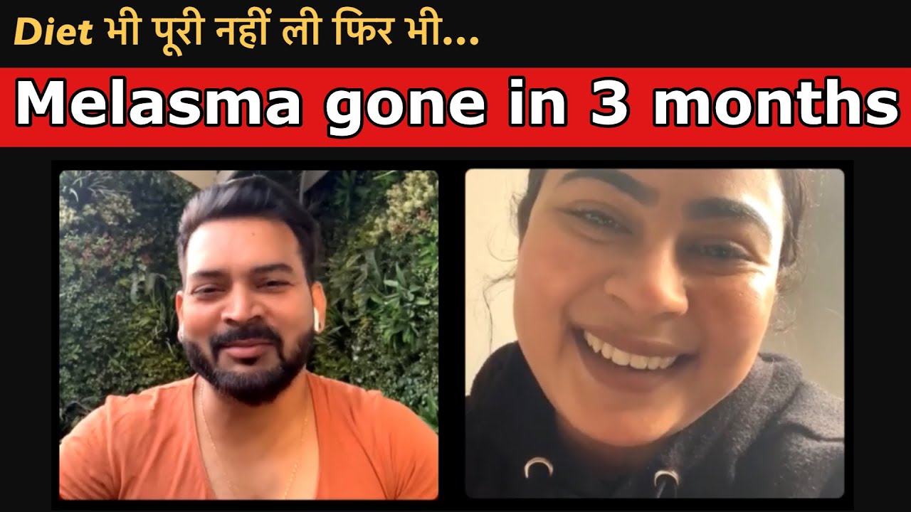 Diet भी पूरी नहीं ली फिर भी…My 60% Melasma gone in 3 months 🥰