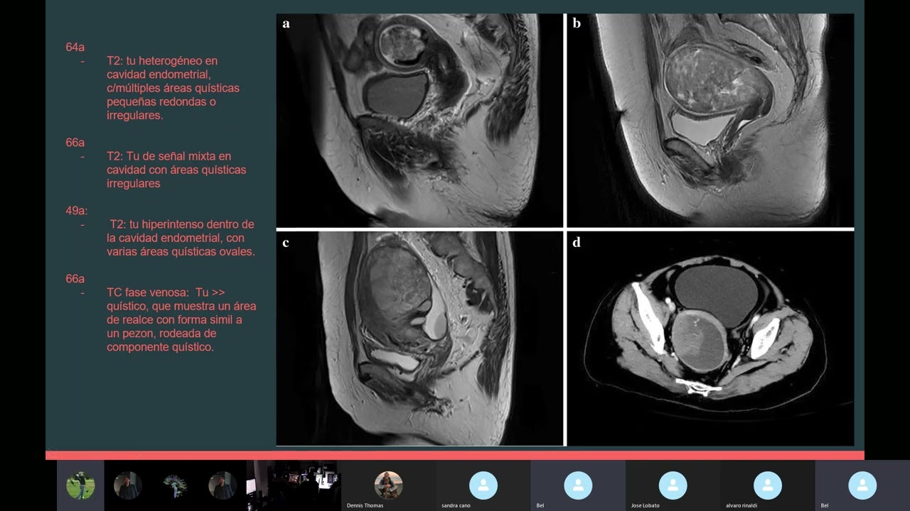 Carcinosarcoma Cérvico Uterino