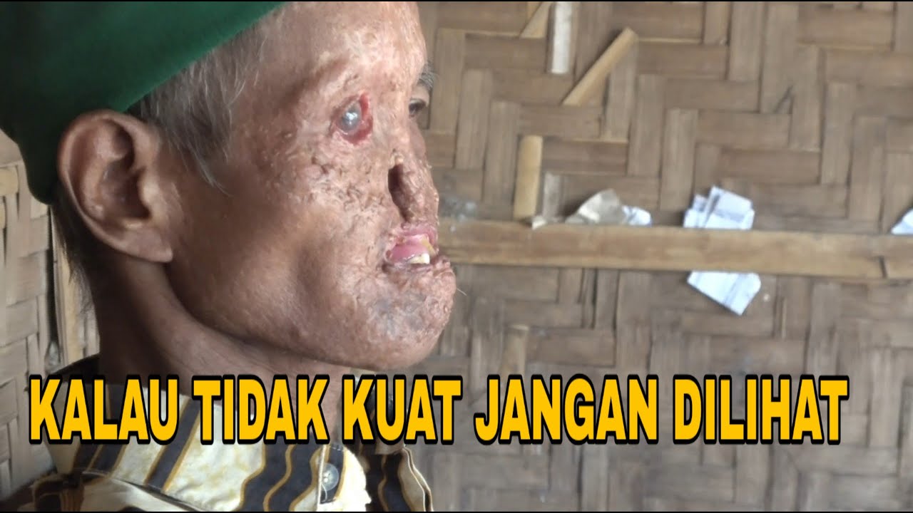 DERITA YANG TAK BERUJUNG...!!! KAKEK PENYANDANG KANKER. Membuat netizen menangis