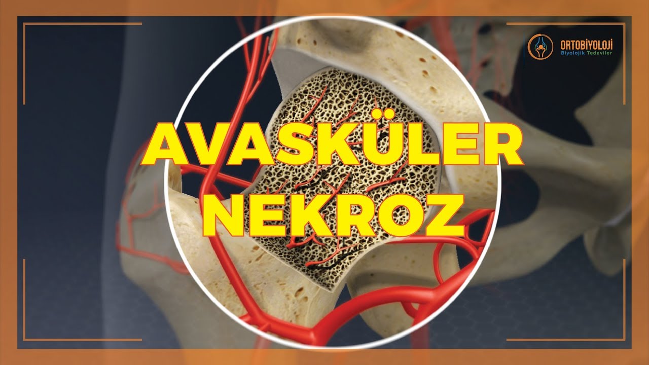 AVASKÜLER NEKROZ TEDAVİLERİ