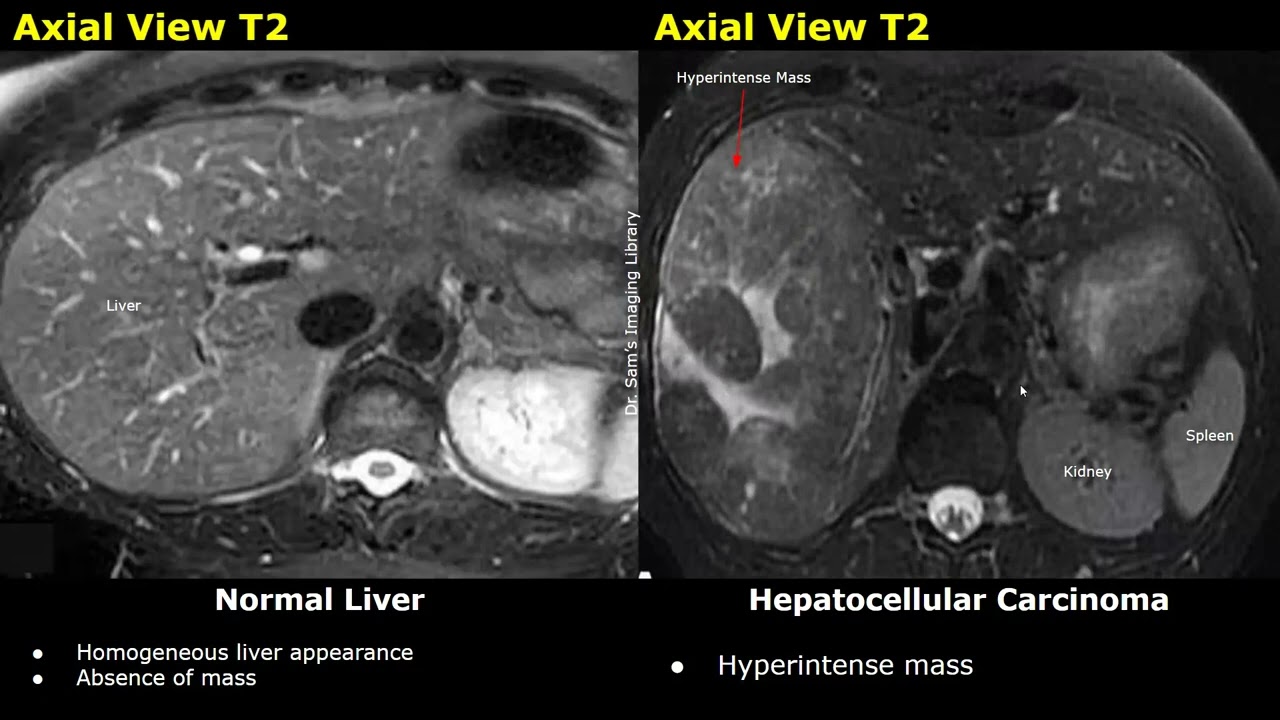 Liver MRI Normal Vs Hepatocellular Carcinoma (HCC) Images | T1, T2, DWI, ADC & Contrast Sequences
