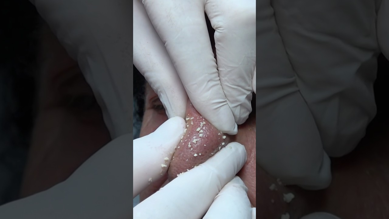 BARBER FACE AND NOSE OIL REMOVAL - MASSAGE - CRACKS #asmracmp #massage #barber #sleep #relax #masaj