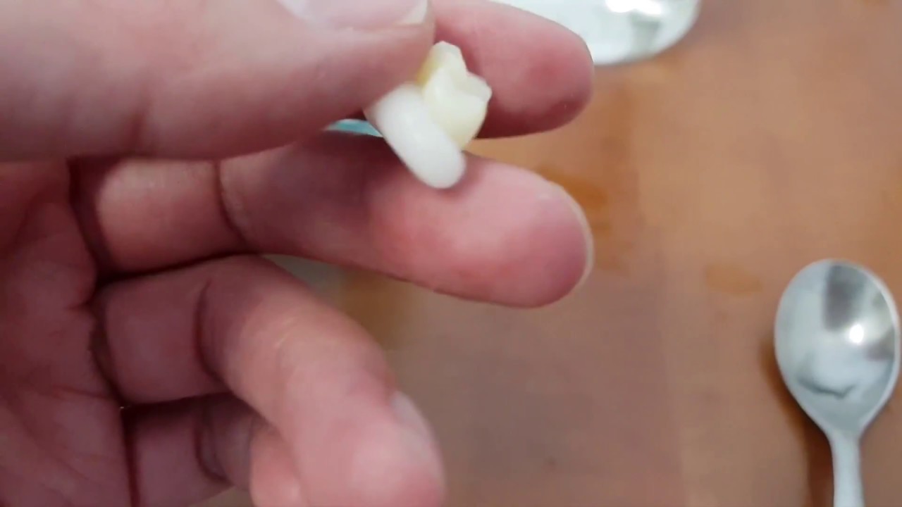 Denticor - predstavenie zubných náhrad časť 2