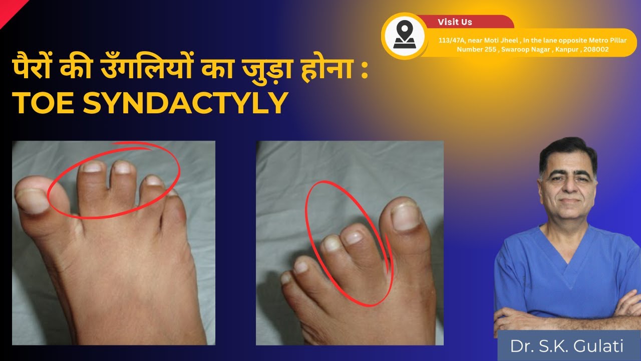 Joined toes since birth :Toe syndactyly:पैरों की पैदाइशी जुड़ी उँगलियों की सर्जरी@DrSKGulati