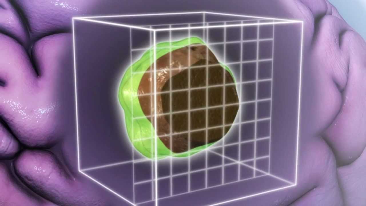 Proton Beam Therapy - Mayo Clinic