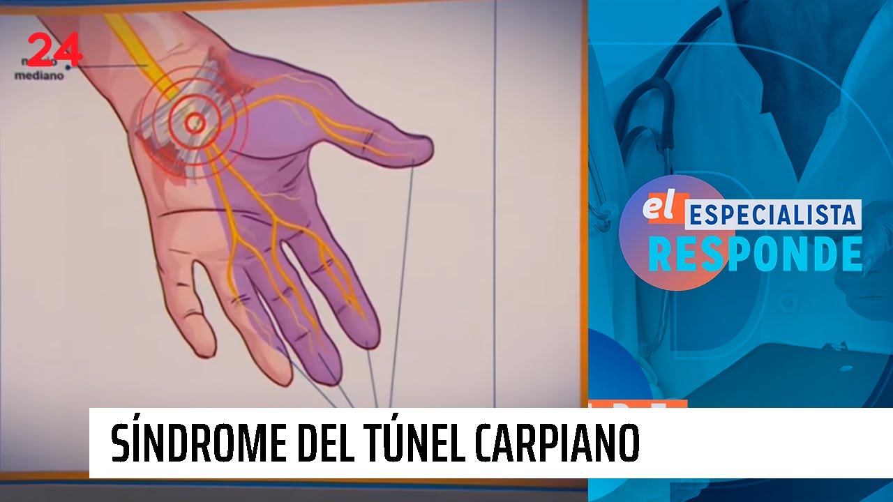 El Especialista responde: qué es y cómo afecta el Síndrome del túnel carpiano | 24 Horas TVN Chile