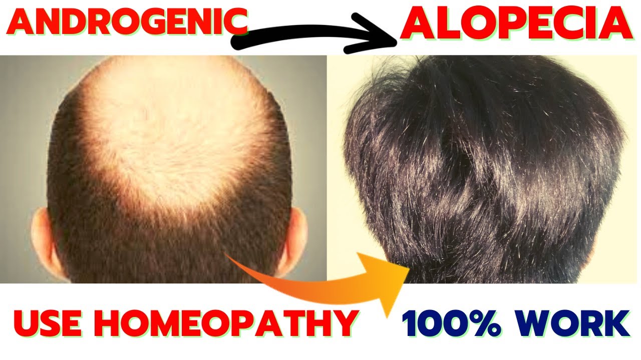 Homeopathy Medicine For Androgenic Alopecia | Homeopathy Medicine For Hair Fall And Regrowth