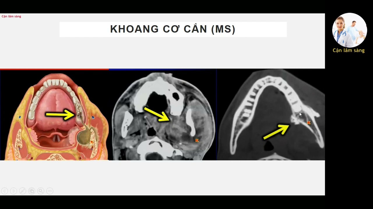 CÁCH ĐỌC CT SCAN VÙNG CỔ