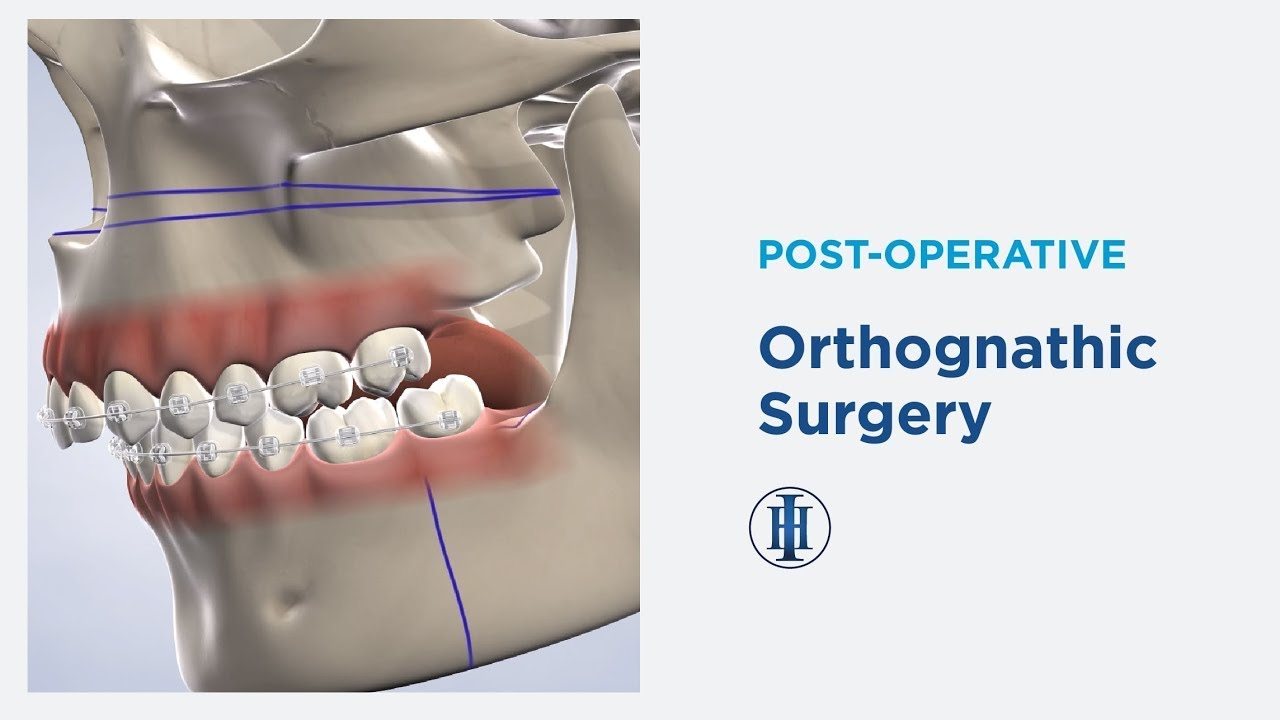 Post-Operative Instructions: Orthognathic Surgery