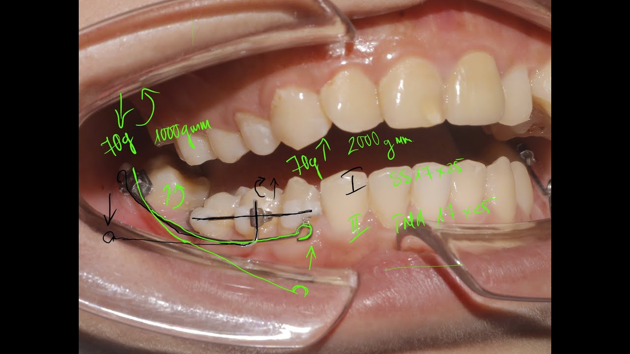 Dựng trục răng 7 hàm dưới, các tình huống lâm sàng và ưu nhược điểm các công cụ