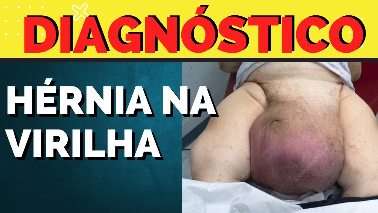 Como é o diagnóstico de HÉRNIA INGUINAL??