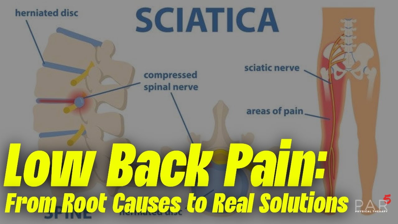 Low Back Pain: From Root Causes to Real Solutions