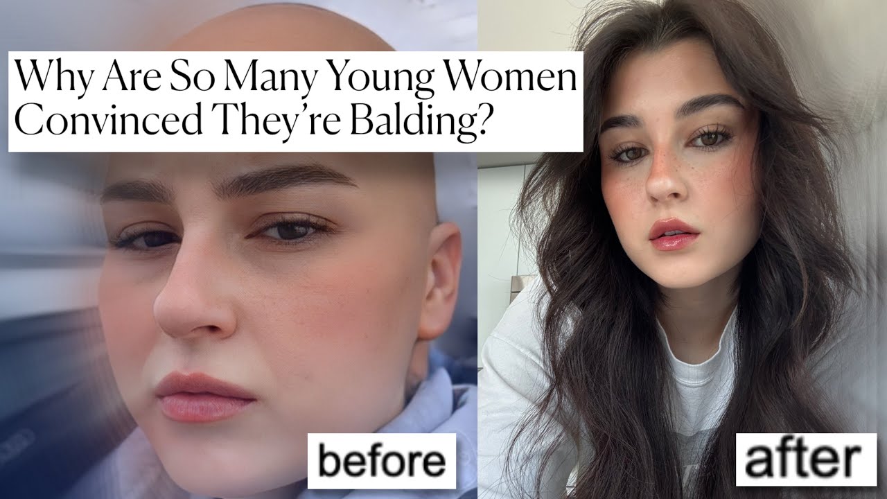 if you're worried you're going bald, this video is for you.
