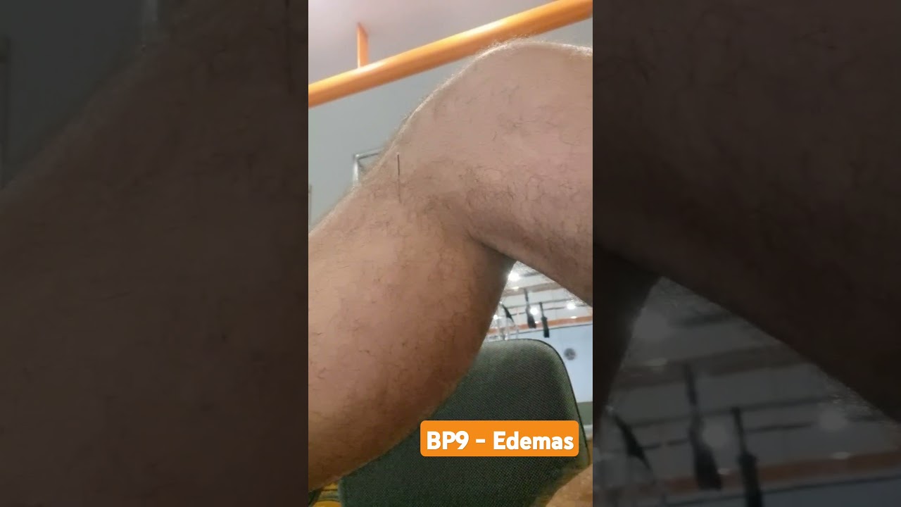 BP9 - Edemas #acupuntura