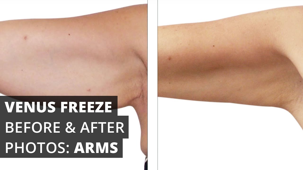 Venus Freeze™ Before & After Photos: Arms