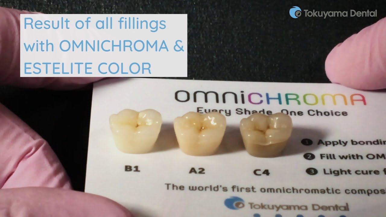 Example of use: OMNICHROMA by TOKUYAMA DENTAL