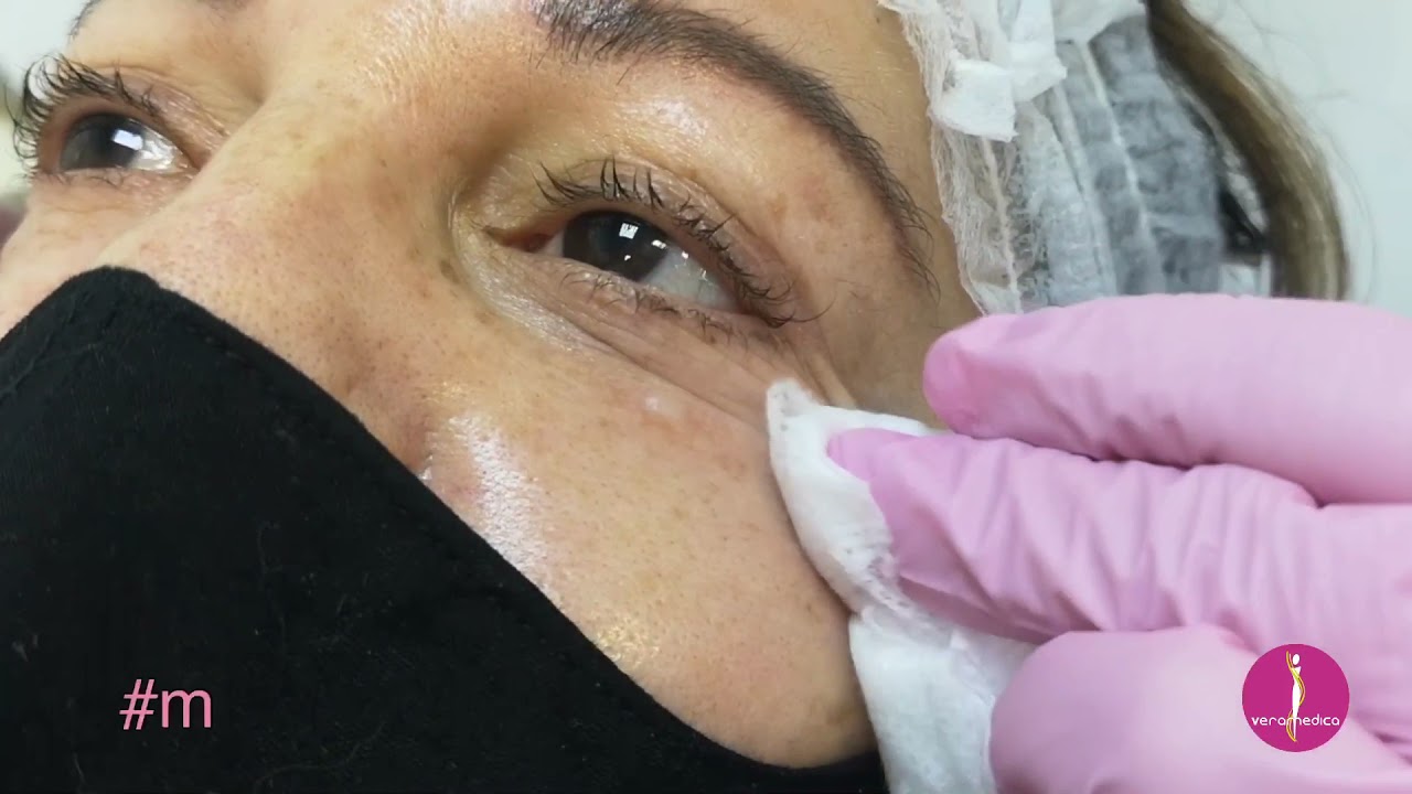 Tratamiento con Mesoterapia Sunekos 200 en Contorno de Ojos, 🤩 +colágeno +hidratación