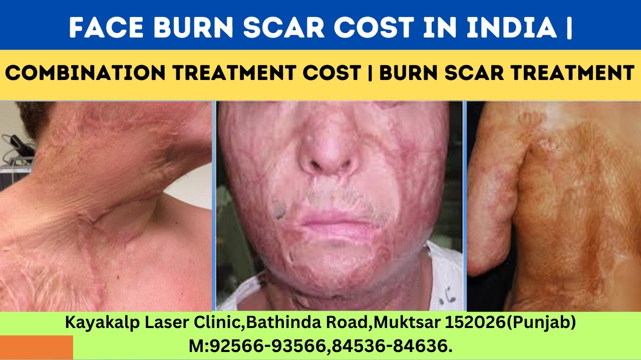 Face Burn Scar Cost In India | Combination Treatment Cost | Burn Scar Treatment