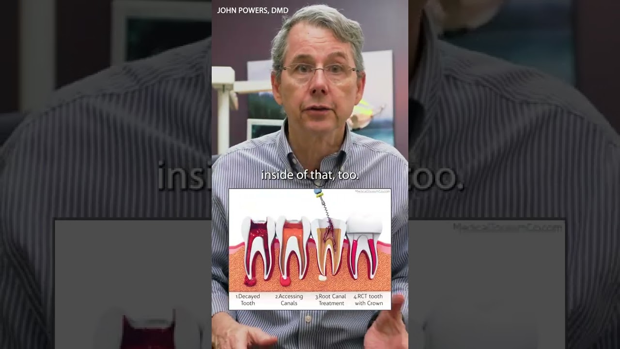 What happens after a root canal? #shorts