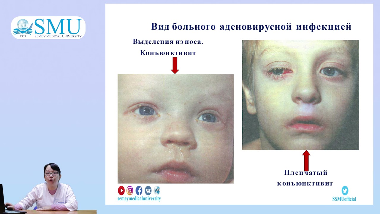 Грипп и ОРВИ у детей