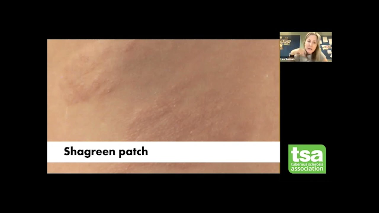 TSC and skin