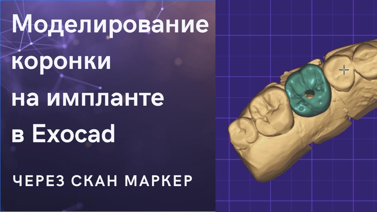 Коронка на импланте за 30 минут в Exocad. Design implant crown with scan-marker