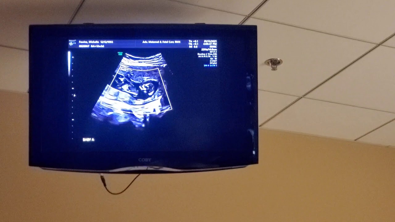 12 Week 3 Day Di/Di Twin Ultrasound With Gender Prediction and 3D