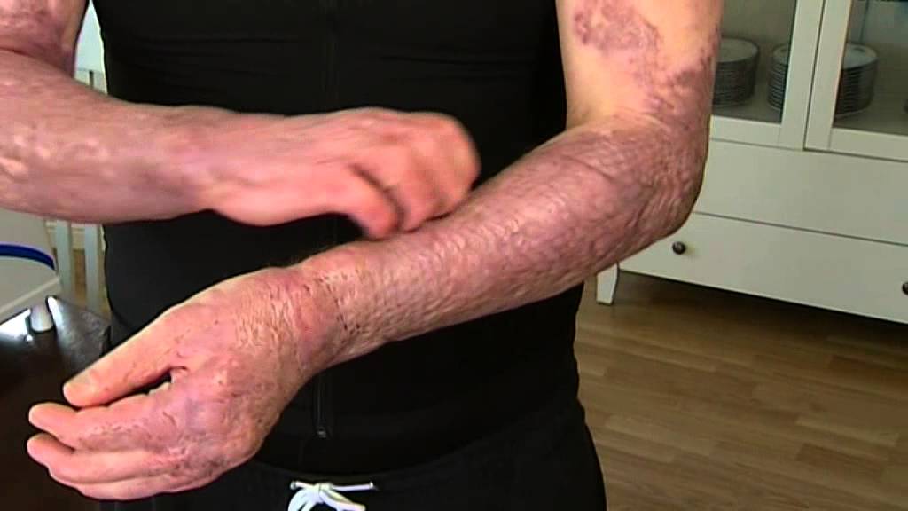 Här spirar det efter branden - Nyheterna (TV4)