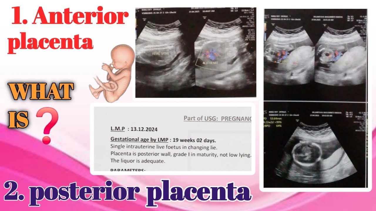 Anterior /posterior placenta মানেই কী ছেলে বা মেয়ে হবে, তাহলে জেনে নি আসল মানে কী 😮😮
