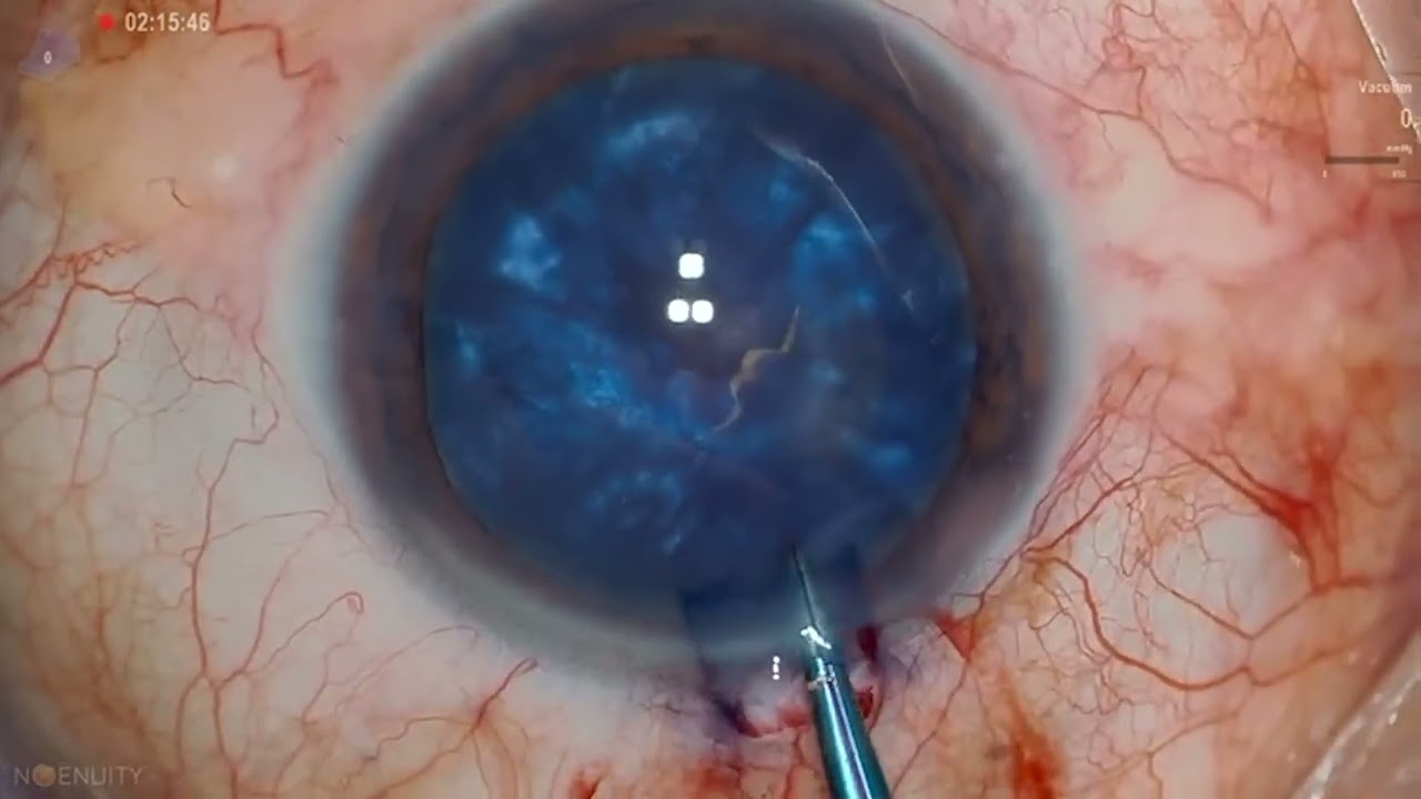 Automated capsular decompression to avoid Argentinian Flag Sign &ndash; VideoS1 [465837]