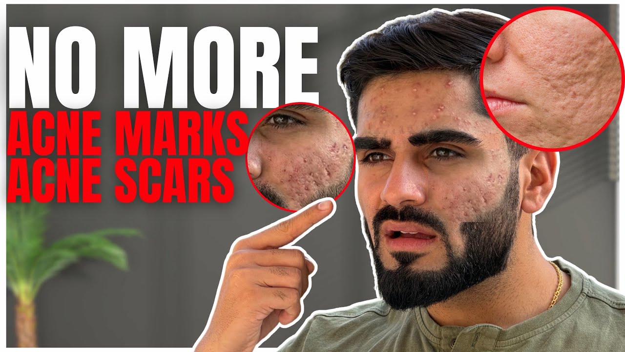 NO MORE ACNE MARKS & ACNE SCARS!😳 Ultimate Teenage Guide to Clear Skin Fast.✨