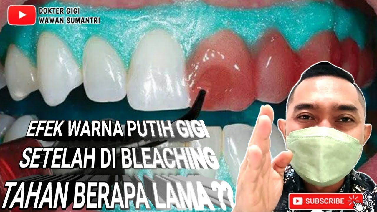 BLEACHING GIGI TAHAN BERAPA LAMA ?? #pemutihgigi #bleachinggigi #toothwhitening #dentist #doktergigi