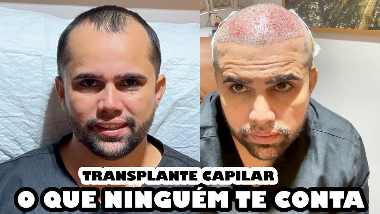 TRANSPLANTE CAPILAR: O QUE NINGUÉM TE CONTOU SOBRE O DIA DA CIRURGIA E CUIDADOS PÓS-OPERATÓRIOS