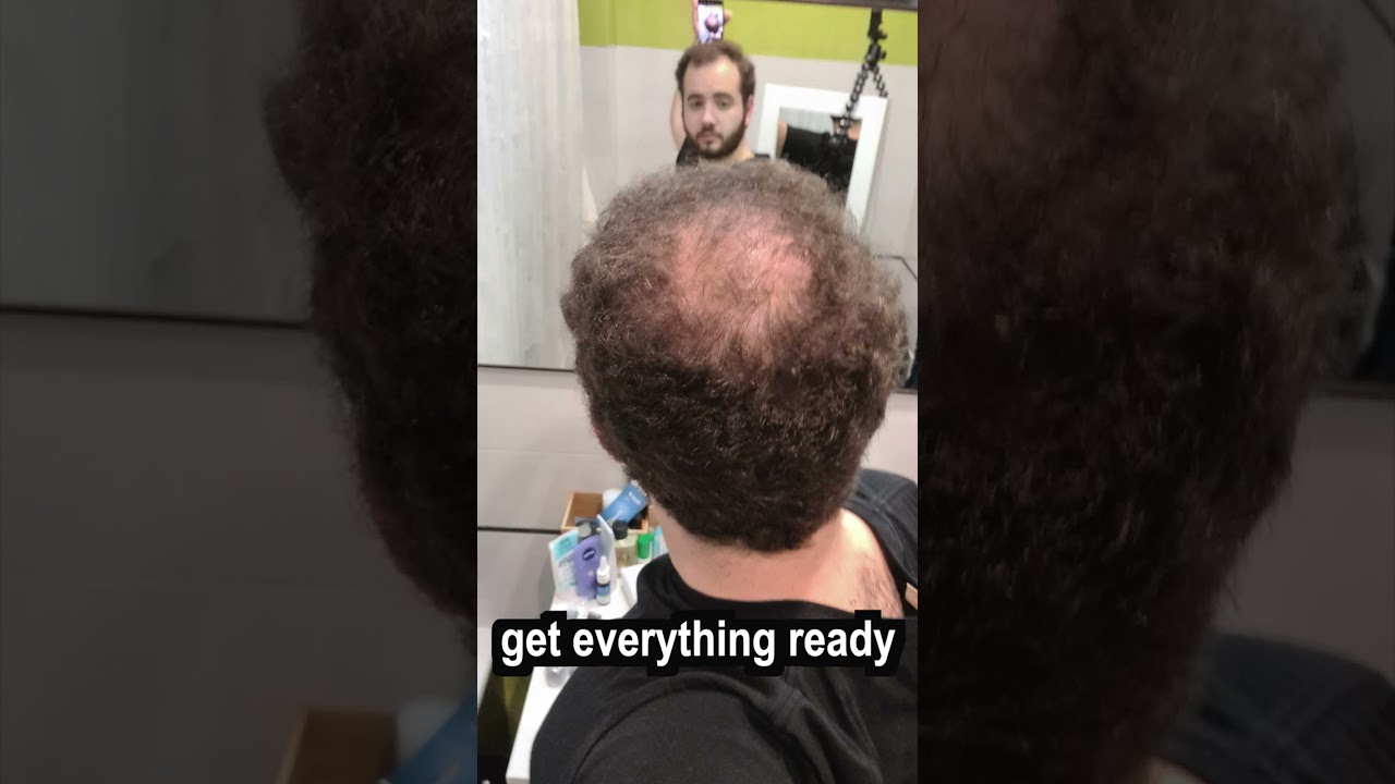 Can You Actually Accept Going Bald? #balding #baldcafe #goingbald