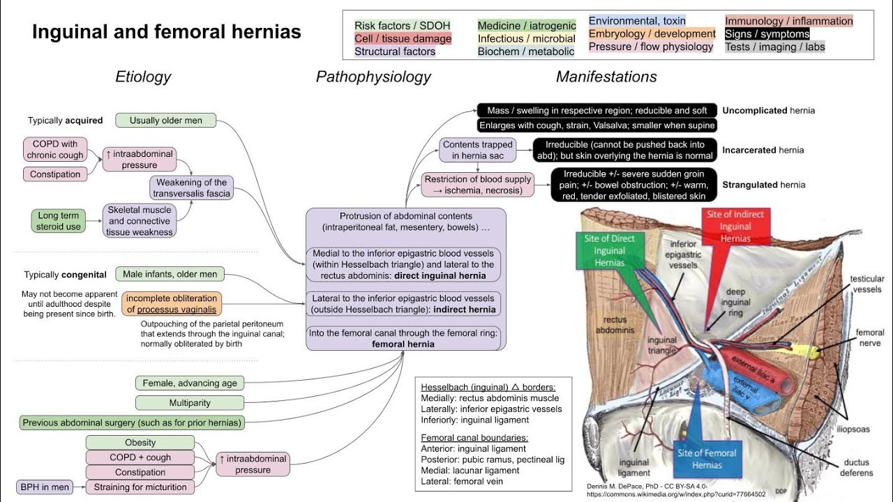 Inguinal and femoral hernias (mechanism of disease)
