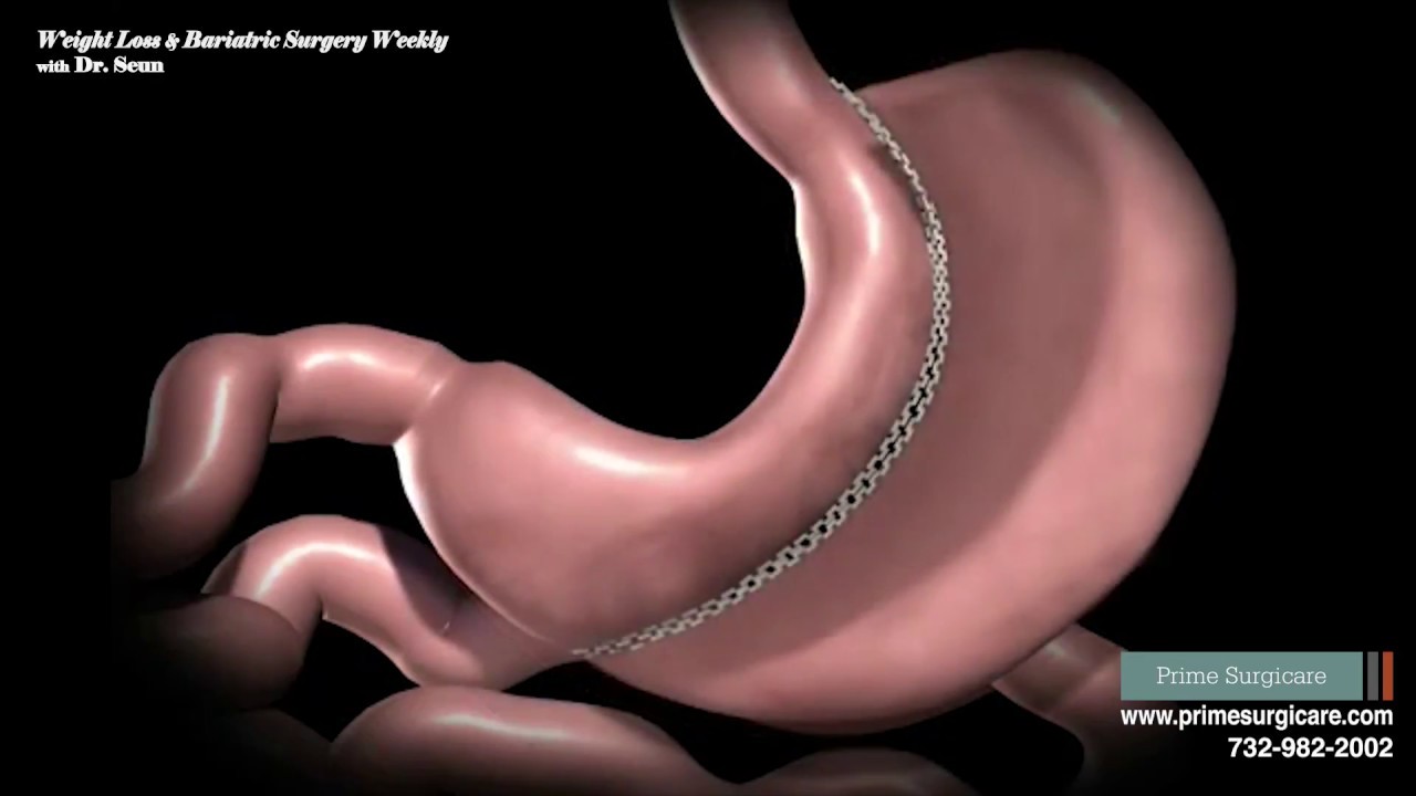 Which Weight Loss Surgery Operation is Right for Me?
