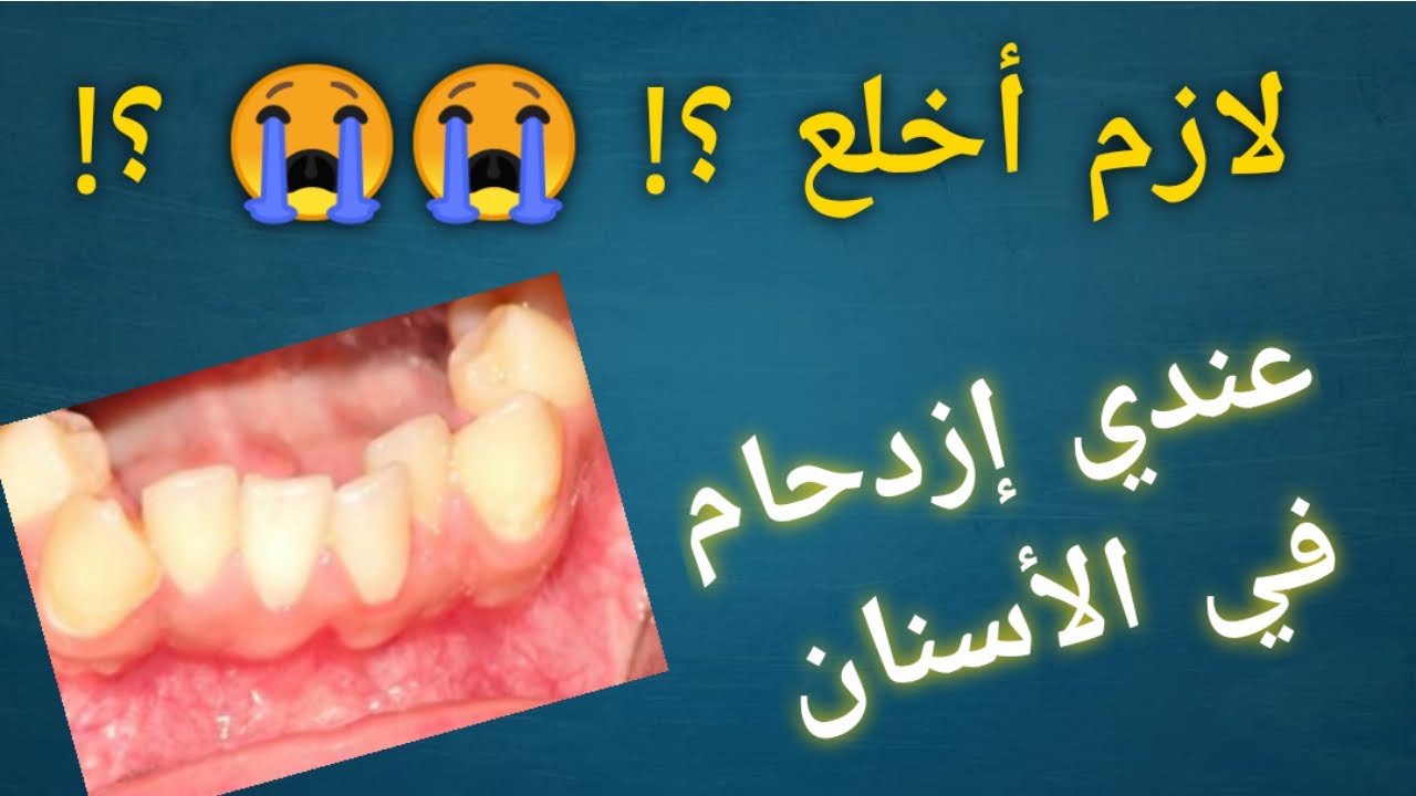 عندي أزدحام ف الأسنان … هل يلزم خلع ؟???????????  Crowding