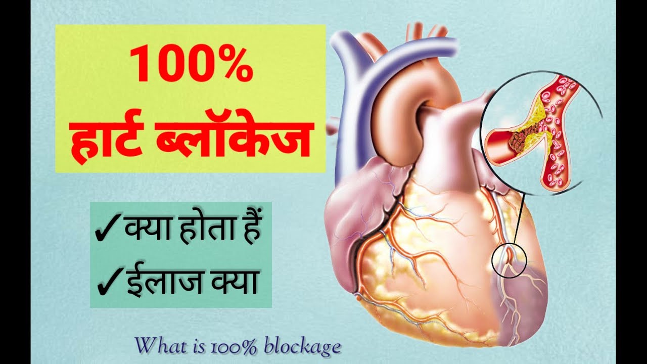 100% heart Blockage Treatment  #drnagendrathalor