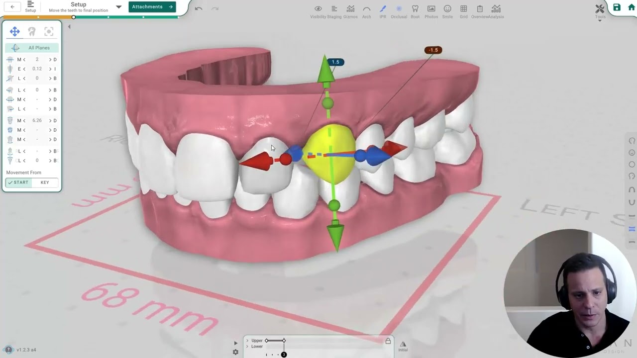 Новая полностью автоматическая сегментация в Titan Dental Design и взгляд в будущее