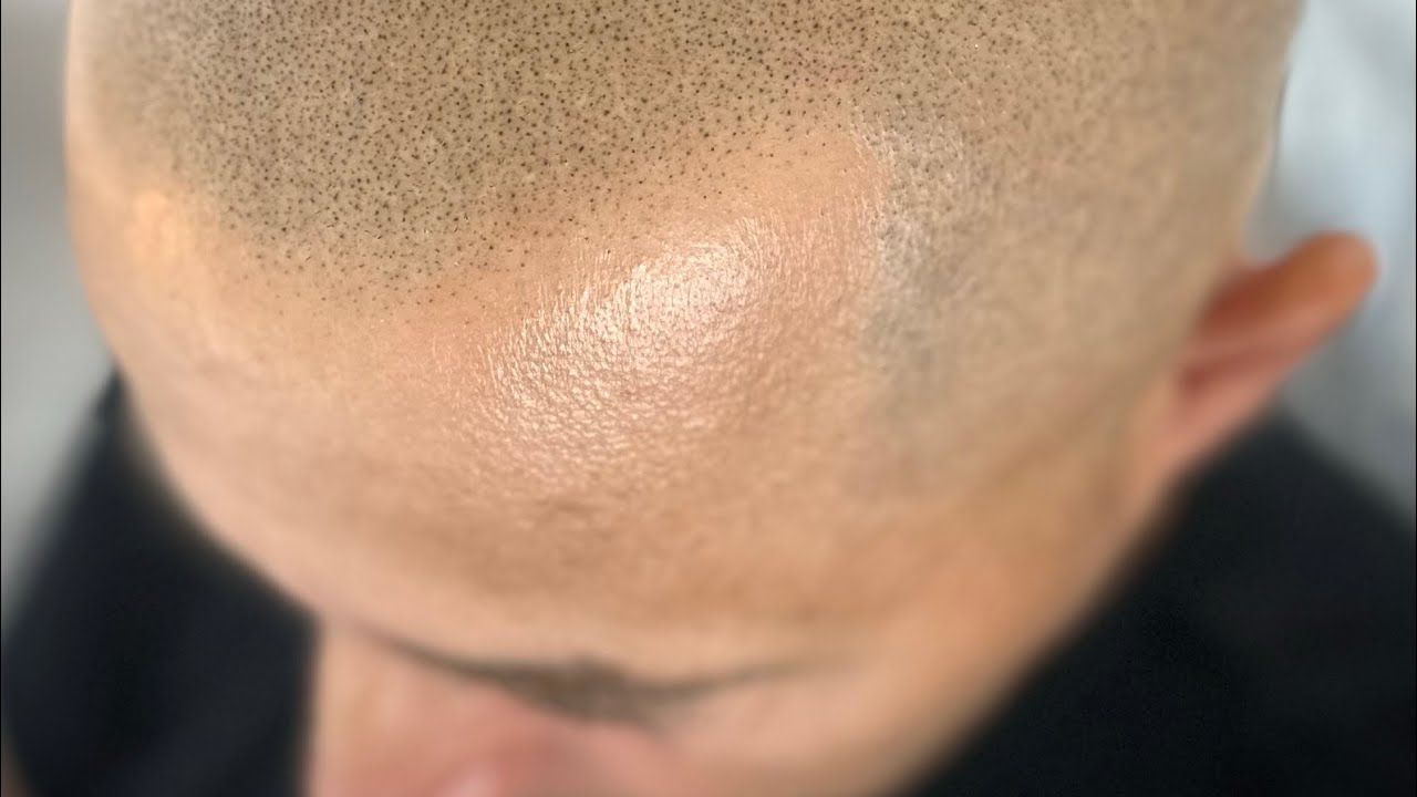 Tricopigmentation en 1 mn30