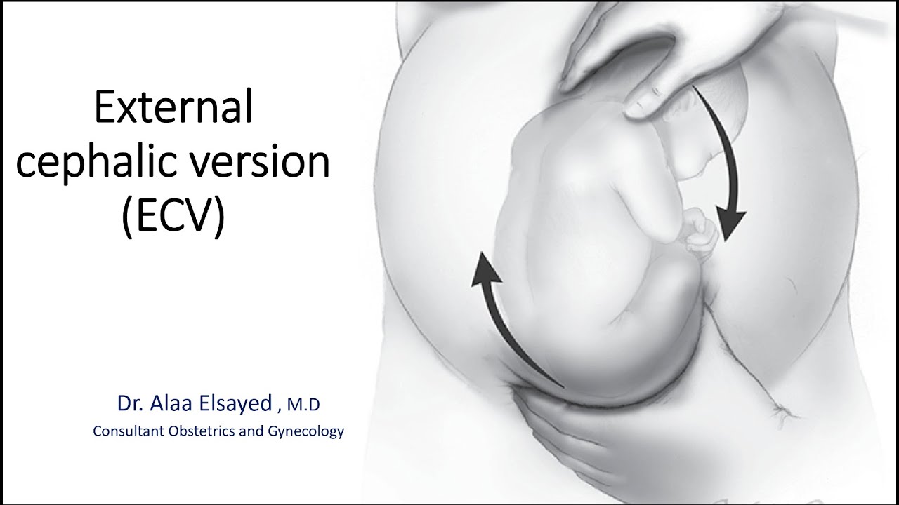 External cephalic version (ECV)