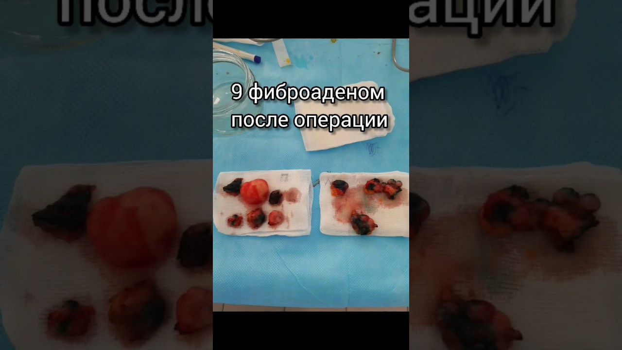 Про удаление фиброаденом из молочных желез на местной анестезии #shorts #операция #фиброаденома