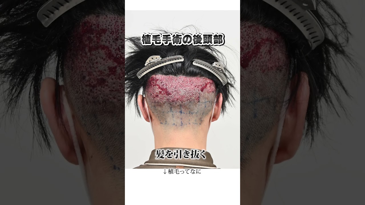 【閲覧注意】植毛手術をした男性の後頭部