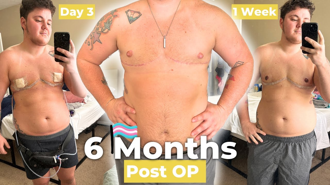 6 месяцев после операции Top Surgery