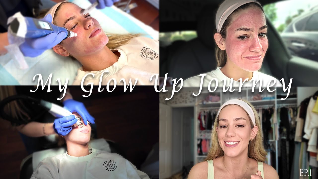 GLOW UP SERIES | Road To The Wedding: I get Microneedling done! | Ep. 1