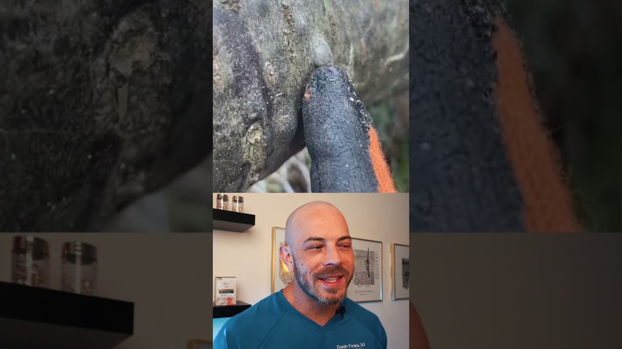 Sappy pimple pops! #dermreacts #doctorreacts #pimplepop