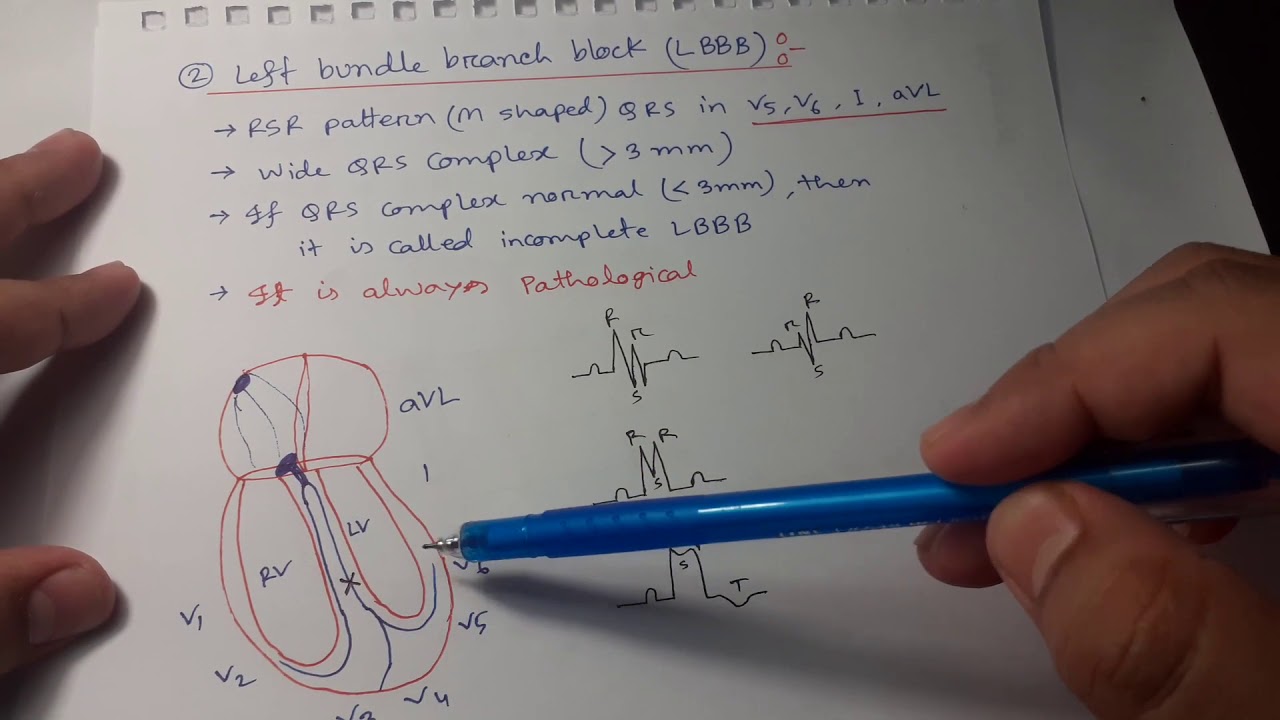 Clinical ECG Interpretation in Bangla (Part-3): RBBB, LBBB, Bifascicular & Trifascicular block