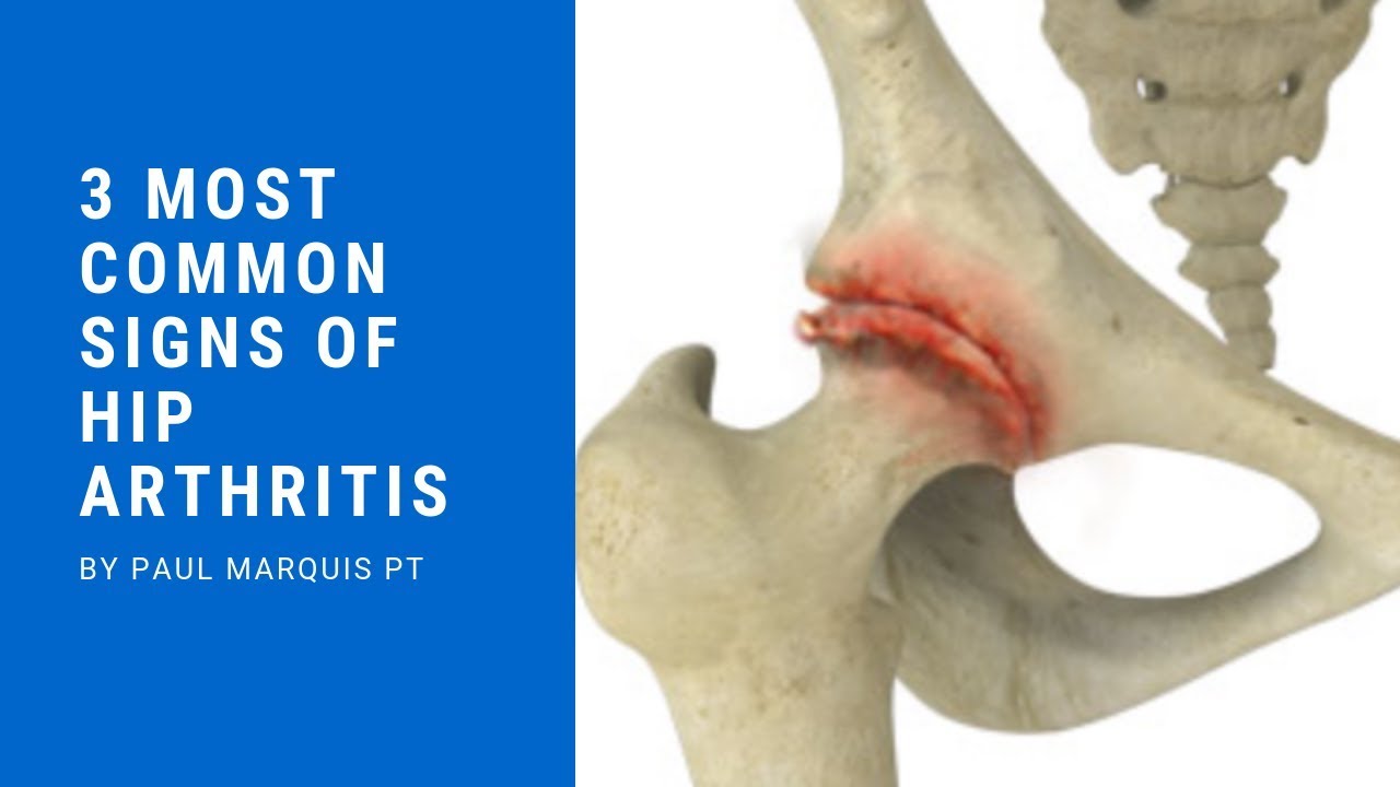 3 Most Common Signs of Hip Arthritis