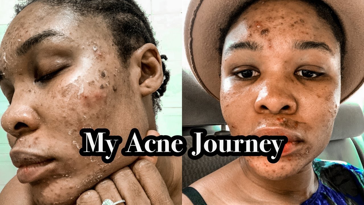 EXPOSING MY INSECURITIES WITH MY ACNE JOURNEY | PART 1